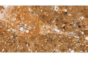 Immunohistochemistry of paraffin-embedded Human breast cancer using TBC1D4 Polyclonal Antibody at dilution of 1:40 (TBC1D4 antibody)