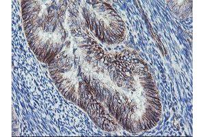 Immunohistochemical staining of paraffin-embedded Adenocarcinoma of Human endometrium tissue using anti-DTNB mouse monoclonal antibody. (Dystrobrevin beta antibody)