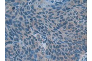 IHC-P analysis of Human Esophagus cancer Tissue, with DAB staining. (Acetylcholinesterase antibody  (AA 366-554))
