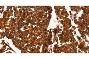 Immunohistochemistry of paraffin-embedded Human breast cancer using CUEDC2 Polyclonal Antibody at dilution of 1:50 (CUEDC2 antibody)