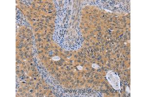 Immunohistochemistry of Human cervical cancer using BRS3 Polyclonal Antibody at dilution of 1:50 (BRS3 antibody)