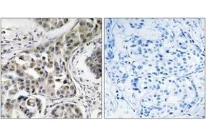 Immunohistochemistry analysis of paraffin-embedded human breast carcinoma, using USP6NL Antibody. (USP6NL antibody  (AA 451-500))