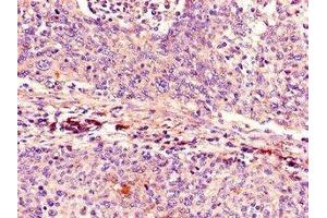 Immunohistochemistry of paraffin-embedded human cervical cancer using  at dilution of 1:100 (CDKN2A antibody  (AA 1-86))