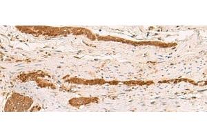Immunohistochemistry of paraffin-embedded Human liver cancer tissue using ZFYVE27 Polyclonal Antibody at dilution of 1:50(x200)