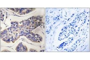 Immunohistochemistry analysis of paraffin-embedded human breast carcinoma tissue, using TAOK1 Antibody. (TAO Kinase 1 (TAOK1) (AA 431-480) antibody)