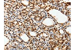 The image on the left is immunohistochemistry of paraffin-embedded Human thyroid cancer tissue using ABIN7192627(SPATA20 Antibody) at dilution 1/70, on the right is treated with synthetic peptide. (SPATA2 antibody)