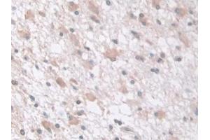 Detection of tPK1 in Human Glioma Tissue using Polyclonal Antibody to Tau-Protein Kinase 1 (tPK1) (TPK1 antibody  (AA 34-300))