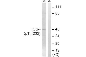 Immunohistochemistry analysis of paraffin-embedded human breast carcinoma tissue using FOS (Phospho-Thr232) antibody. (c-FOS antibody  (pThr232))