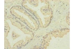 Immunohistochemistry of paraffin-embedded human prostate cancer using ABIN7172905 at dilution of 1:100 (MTIF3 antibody  (AA 1-278))