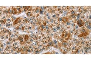 Immunohistochemistry of paraffin-embedded Human liver cancer tissue using CYP27A1 Polyclonal Antibody at dilution 1:50 (CYP27A1 antibody)