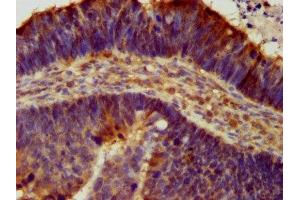IHC image of ABIN7143000 diluted at 1:300 and staining in paraffin-embedded human ovarian cancer performed on a Leica BondTM system. (ACCN1 antibody  (AA 197-345))