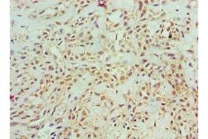 Immunohistochemistry of paraffin-embedded human breast cancer using ABIN7143157 at dilution of 1:100 (ASCC3 antibody  (AA 1-111))
