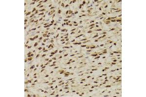Immunohistochemistry of paraffin-embedded Human adenomyosis using ANP32A antibody at dilution of 1:100 (x400 lens). (PHAP1 antibody)