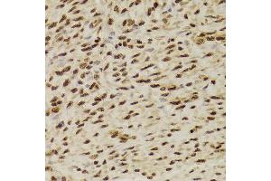 Immunohistochemistry of paraffin-embedded Human adenomyosis using ANP32A antibody at dilution of 1:100 (x400 lens).