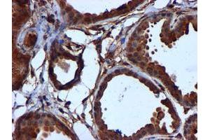 Immunohistochemical staining of paraffin-embedded Human breast tissue using anti-CYB5R3 mouse monoclonal antibody. (CYB5R3 antibody)