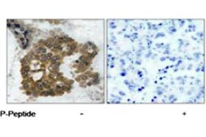 Immunohistochemical analysis of paraffin-embedded human lung carcinoma tissue using AKT2 (phospho S474) polyclonal antibody . (AKT2 antibody  (pSer474))