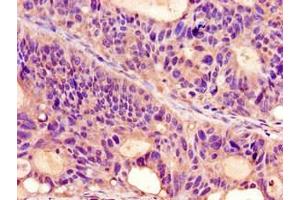 Immunohistochemistry of paraffin-embedded human colon cancer using ABIN7164713 at dilution of 1:100 (Prokineticin Receptor 2 antibody  (AA 1-45))