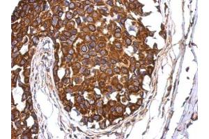 IHC-P Image Immunohistochemical analysis of paraffin-embedded human breast cancer, using Aladin, antibody at 1:500 dilution. (Adracalin antibody  (Internal Region))