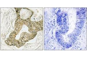 Immunohistochemistry analysis of paraffin-embedded human breast carcinoma tissue, using p90 RSK (Ab-380) Antibody. (RPS6KA3 antibody  (AA 346-395))
