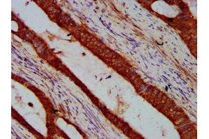 IHC image of ABIN7169218 diluted at 1:600 and staining in paraffin-embedded human colon cancer performed on a Leica BondTM system. (VRK2 antibody  (AA 317-472))