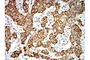 Immunohistochemical analysis of paraffin-embedded stomach cancer tissues using KRT19 mouse mAb with DAB staining. (Cytokeratin 19 antibody  (AA 274-400))
