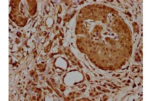 IHC image of ABIN7154863 diluted at 1:700 and staining in paraffin-embedded human pancreatic cancer performed on a Leica BondTM system. (HSP70 1A antibody  (AA 291-641))