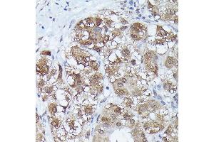 Immunohistochemistry of paraffin-embedded human liver cancer using MT2A Rabbit pAb (ABIN3015841, ABIN3015842, ABIN3015843 and ABIN6219186) at dilution of 1:150 (40x lens). (MT2A antibody  (AA 1-61))