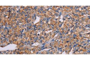 Immunohistochemistry of paraffin-embedded Human prostate cancer tissue using GHITM Polyclonal Antibody at dilution 1:30