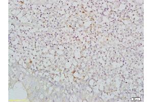Formalin-fixed and paraffin embedded human nasopharyngeal carcinoma labeled with Anti-NKG2D/CD314/KLRK1 Polyclonal Antibody, Unconjugated  at 1:200, followed by conjugation to the secondary antibody and DAB staining (KLRK1 antibody  (AA 121-219))