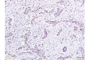 Formalin-fixed and paraffin embedded human tumor tissue labeled with Anti-HPV16-E6 Polyclonal Antibody, Unconjugated at 1:200, followed by conjugation to the secondary antibody and DAB staining (Human Papilloma Virus 16 E6 (HPV-16 E6) (AA 85-158) antibody)