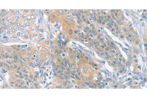 Immunohistochemistry of paraffin-embedded Human cervical cancer using SLIT2 Polyclonal Antibody at dilution of 1:30 (SLIT2 antibody)