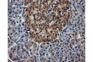 Immunohistochemical staining of paraffin-embedded Adenocarcinoma of ovary tissue using anti-RC201933 mouse monoclonal antibody. (PIM2 antibody)
