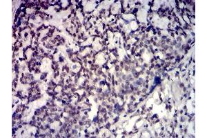 Immunohistochemical analysis of paraffin-embedded esophageal cancer tissues using TBP mouse mAb with DAB staining. (TBP antibody  (AA 1-144))