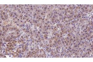 ABIN6273254 at 1/100 staining Human pancreas cancer tissue by IHC-P. (HBS1L antibody  (N-Term))
