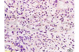 Formalin-fixed and paraffin embedded human glioma tissue labeled with Anti-Integrin beta 7 Polyclonal Antibody, Unconjugated (ABIN736941) at 1:200, followed by conjugation to the secondary antibody and DAB staining (Integrin beta 7 antibody  (AA 721-806))