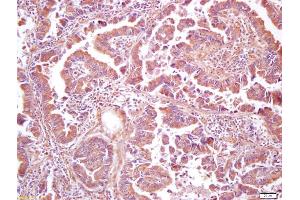 Formalin-fixed and paraffin embedded human lung carcinoma labeled with Anti-phospho-PIK3C3(Ser282) Polyclonal Antibody, Unconjugated (ABIN711656) at 1:200 followed by conjugation to the secondary antibody and DAB staining (PIK3C3 antibody  (pSer282))