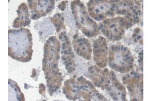 Detection of EPO in Human Thyroid cancer Tissue using Monoclonal Antibody to Erythropoietin (EPO) (EPO antibody  (AA 28-193))