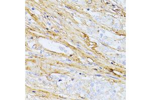 Immunohistochemistry of paraffin-embedded human colon carcinoma using TGFBI antibody (ABIN5971386) at dilution of 1/100 (40x lens).