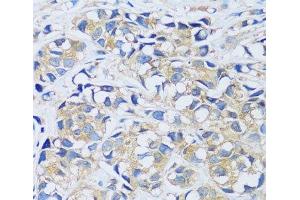 Immunohistochemistry of paraffin-embedded Human breast cancer using CABP7 Polyclonal Antibody at dilution of 1:100 (40x lens). (CABP7 antibody)
