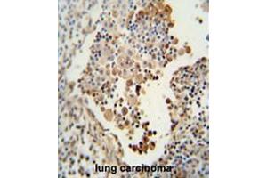 CADM1 antibody (N-term) immunohistochemistry analysis in formalin fixed and paraffin embedded human lung carcinoma followed by peroxidase conjugation of the secondary antibody and DAB staining. (CADM1 antibody  (N-Term))
