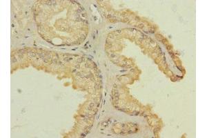 Immunohistochemistry of paraffin-embedded human prostate cancer using ABIN7142631 at dilution of 1:100 (Serotonin Receptor 3B antibody  (AA 22-238))