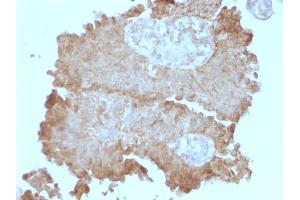 Formalin-fixed, paraffin-embedded human Bladder Carcinoma stained with Protocadherin FAT2 Monoclonal Antibody (8C5). (FAT Atypical Cadherin 2 (FAT2) antibody)