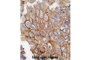 Formalin-fixed and paraffin-embedded human lung carcinoma tissue reacted with ANXA2 antibody (C-term) (ABIN391620 and ABIN2841539) , which was peroxidase-conjugated to the secondary antibody, followed by DAB staining. (Annexin A2 antibody  (C-Term))