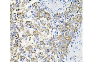 Immunohistochemistry of paraffin-embedded Human esophageal cancer using ACVR2A Polyclonal Antibody at dilution of 1:100 (40x lens).