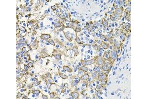 Immunohistochemistry of paraffin-embedded Human esophageal cancer using ACVR2A Polyclonal Antibody at dilution of 1:100 (40x lens). (ACVR2A antibody)