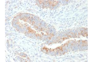 Formalin-fixed, paraffin-embedded human Colon Carcinoma stained with Erythropoietin (EPO) Mouse Monoclonal Antibody (EPO/1367). (EPO antibody  (AA 28-162))