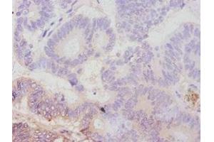 Immunohistochemistry of paraffin-embedded human colon cancer using ABIN7179111 at dilution of 1:100 (AVPR1A antibody  (AA 7-52))