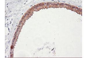 Immunohistochemical staining of paraffin-embedded Human breast tissue using anti-DGKA mouse monoclonal antibody. (DGKA antibody)