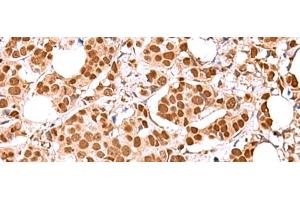Immunohistochemistry of paraffin-embedded Human breast cancer tissue using RCOR3 Polyclonal Antibody at dilution of 1:60(x200) (RCOR3 antibody)