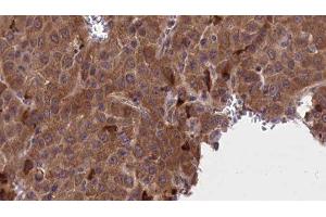 ABIN6277220 at 1/100 staining Human liver cancer tissue by IHC-P. (AP2M1 antibody  (Internal Region))